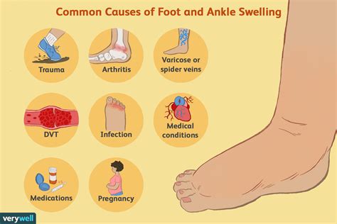 EXERCISES THAT HELP REDUCE INFLAMMATION & EDEMA SWELLING – SwellNoMore