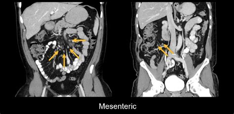 Abdominal CT: lymph nodes • LITFL • Radiology Library