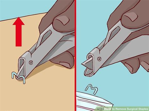 How to Remove Surgical Staples: 8 Steps (with Pictures) - wikiHow