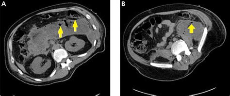 Necrotizing pancreatitis: Diagnose, treat, consult | Cleveland Clinic ...