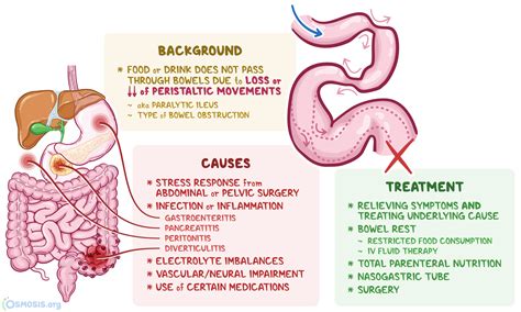 Adynamic Ileus: What Is It, Symptoms, Treatment | Osmosis