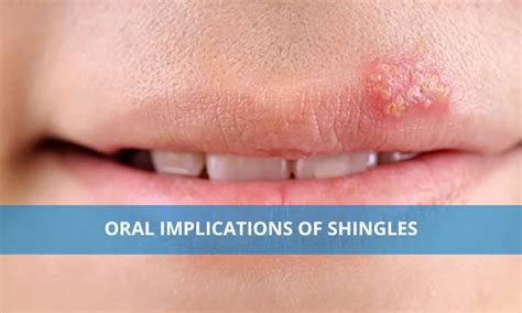 Oral implications of Shingles