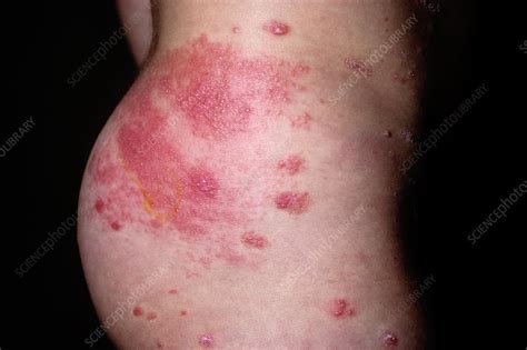 Shingles rash on the buttock - Stock Image - C009/6839 - Science Photo ...