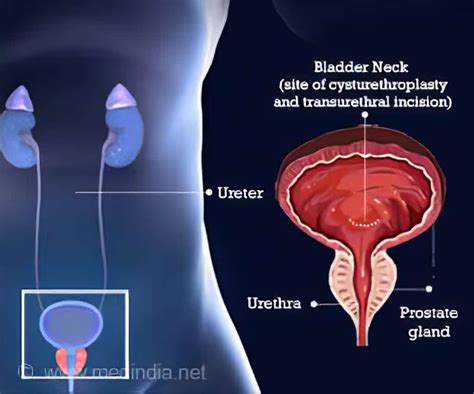 The condition is also known as “Bladder Neck Dysfunction”. It is often ...