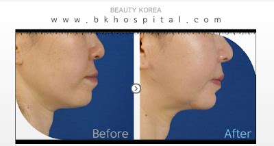 BK Plastic Surgery: [BK Plastic Surgery] Protruding Mouth Correction