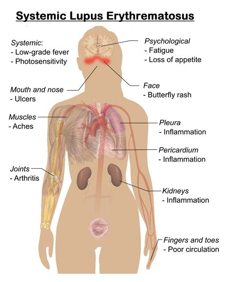 Systemic Lupus Erythematosus (SLE) - MedicoInfo