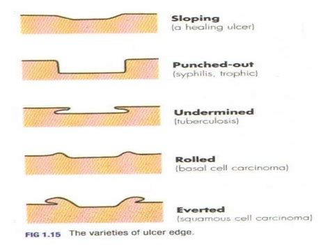 Varieties of ulcer edges