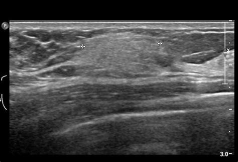 breast lipoma