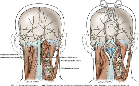 [PDF] Anatomical study of the third occipital nerve and its potential ...