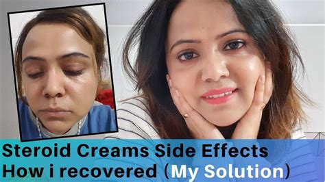 How I Recovered From Steroid cream Side Effects || My Experience ...