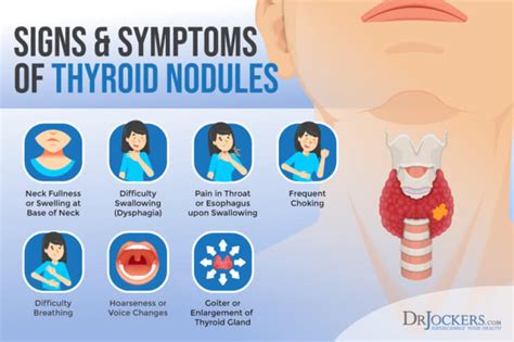 Thyroid Nodules: Symptoms, Causes, and Support Strategies