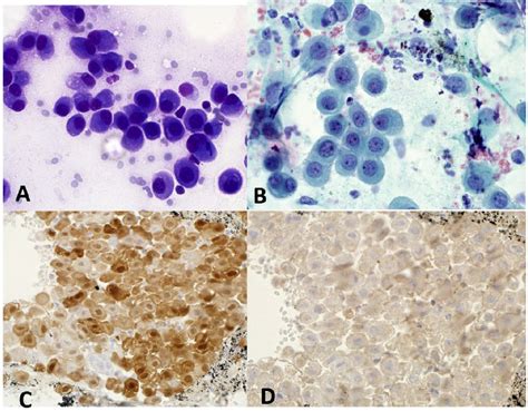 The patient's pleural fluid cytology specimen showing (A)... | Download ...