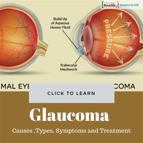 Glaucoma - Causes, Types, Symptoms And Treatment