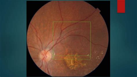 Basic fundoscopy