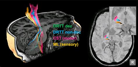 Focused Ultrasound in Neuroscience Program | UCSF Radiology