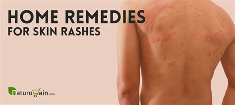 9 Home Remedies for Skin Rashes and Itching that Work [Naturally]