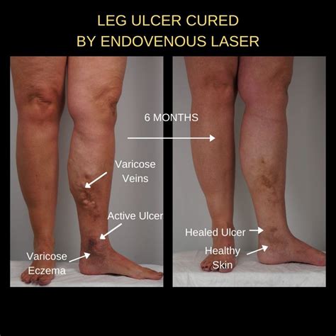 Leg Ulcers | The VeinCare Centre