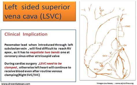 unroofed coronary sinus | Dr.S.Venkatesan MD