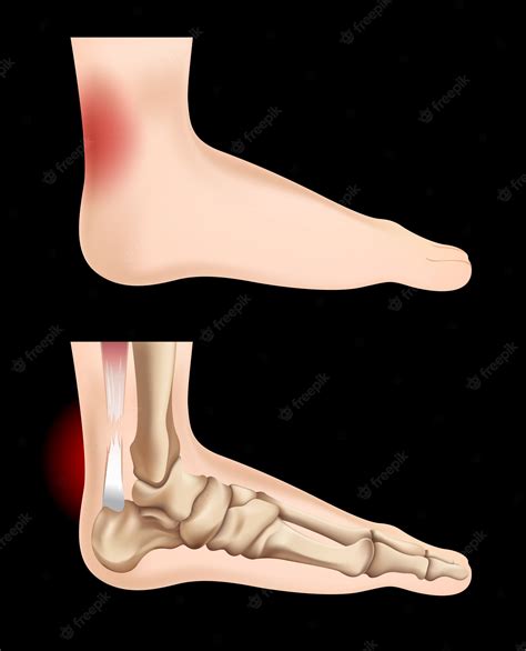 Premium Vector | Diagram showing tendon injury