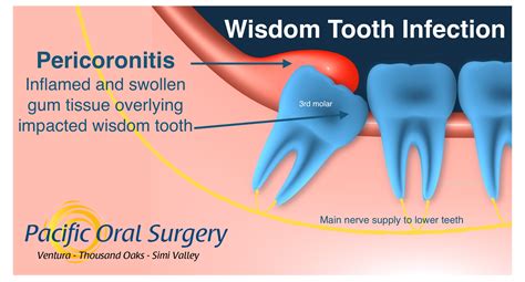 Wisdom Tooth Infection Pacific Oral Surgery - Pacific Oral Surgery