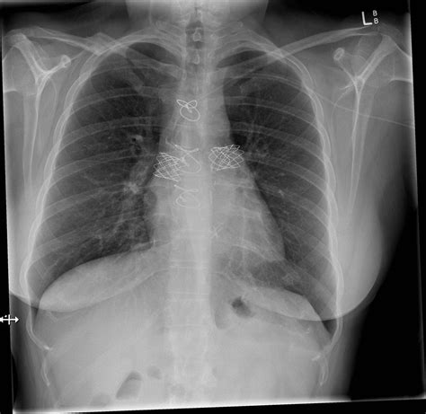 Pulmonary artery stents for stenosis post bilateral lung transplant ...