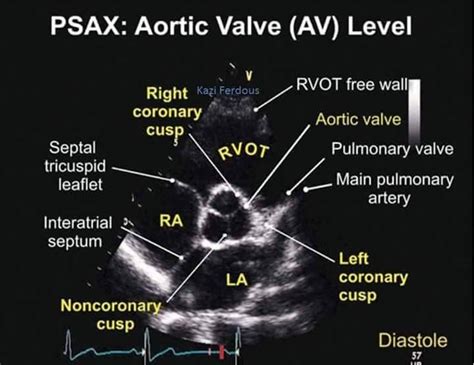 How to do Echocardiography | Standard Protocol for Performing ...