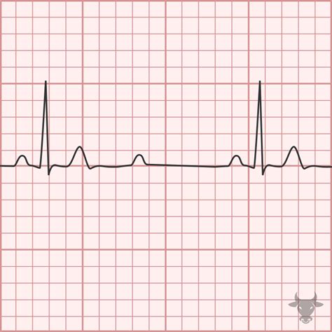 Second Degree Atrioventricular Block 2:1 | ECG Stampede