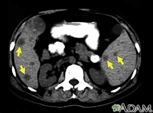 Abdominal CT scan Information | Mount Sinai - New York