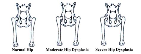 Hip Dysplasia | MVS Hospital