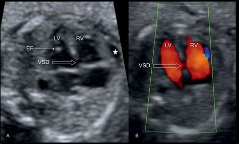 Ventricular Septal Defect