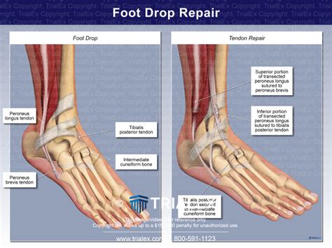 Foot Drop Repair - TrialQuest Inc.