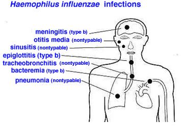 Haemophilus influenzae