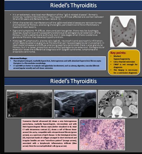 Sthanu on Twitter: "@AaronGoodman33 Riedel fibrosing thyroiditis Riedel ...