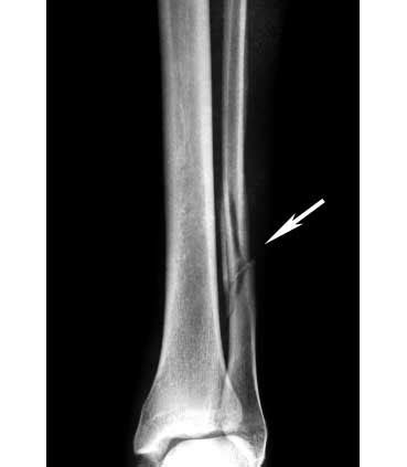 Fibula Fracture - Types, Symptoms, Causes and Rehabilitation