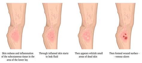 Venous Leg Ulcers: Symptoms, Diagnosis & Treatment