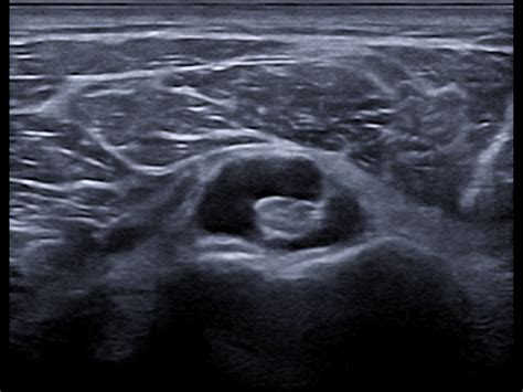 Long head of the biceps tenosynovitis | Ultrasound Cases