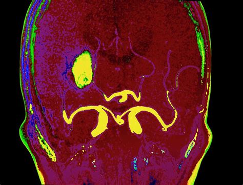 Coloured Mri Scan Of A Cerebral Infarction Photograph by Simon Fraser ...