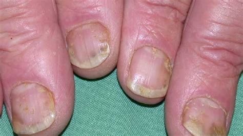 Nail Psoriasis: Symptoms, Causes & Treatments – NailDesignCode