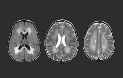 About MLD Metachromatic Leukodystrophy | MLD Support Association UK