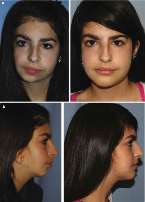 Hemifacial microsomia causes, signs, symptoms, diagnosis & treatment