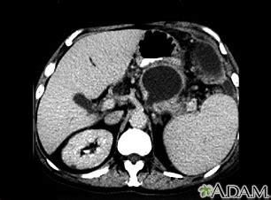 Pancreatic pseudocyst, CT scan | Allina Health