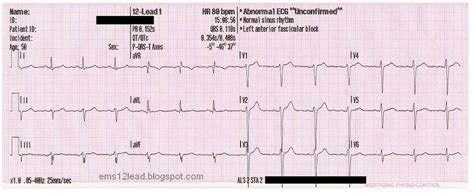 Left Anterior Fascicular Block (LAFB)