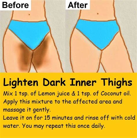 6 Home Remedies to Get Rid of Dark Inner Thighs: Lighten Dark Inner ...