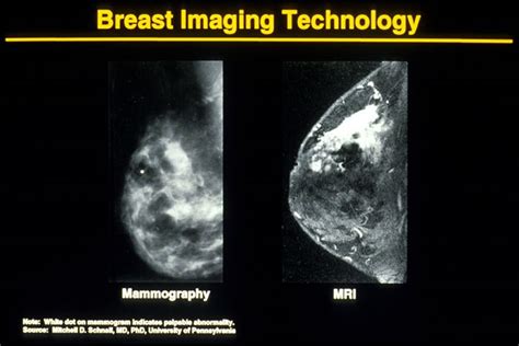 Mammogram Images: Normal and Abnormal