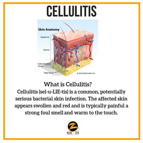 What is Cellulitis?