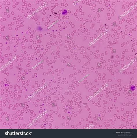 Microscopic View Blood Smear Hereditary Hemolytic Stock Photo ...