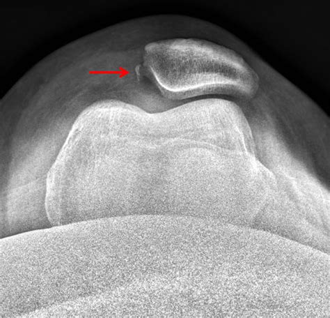 Lateral Femoral Condyle Avulsion Fracture