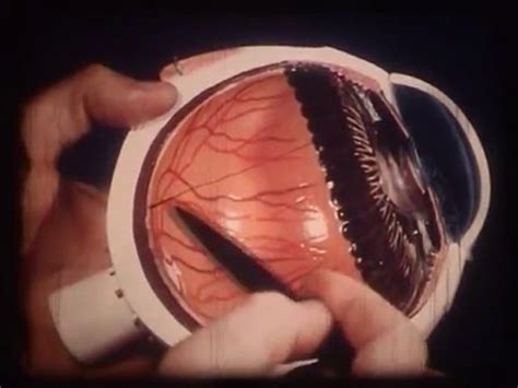 "Aphakia is the first complication of cataract surgery" By: Prof. Jan ...