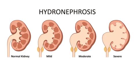 Hydronephrosis (Kidney Swelling) - Symptoms & Causes | Gleneagles Hospital