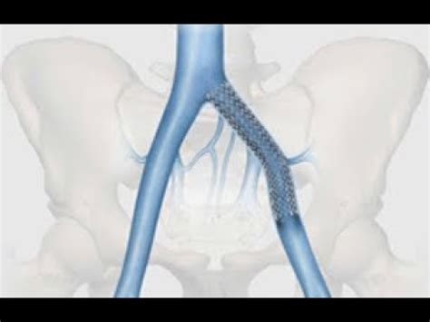 WN - common iliac vein